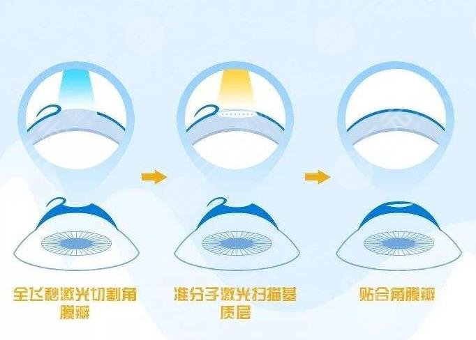 近视眼手术技术革新,从过去走向未来的最新进展